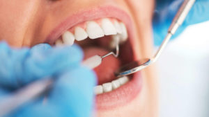 root canal procedure